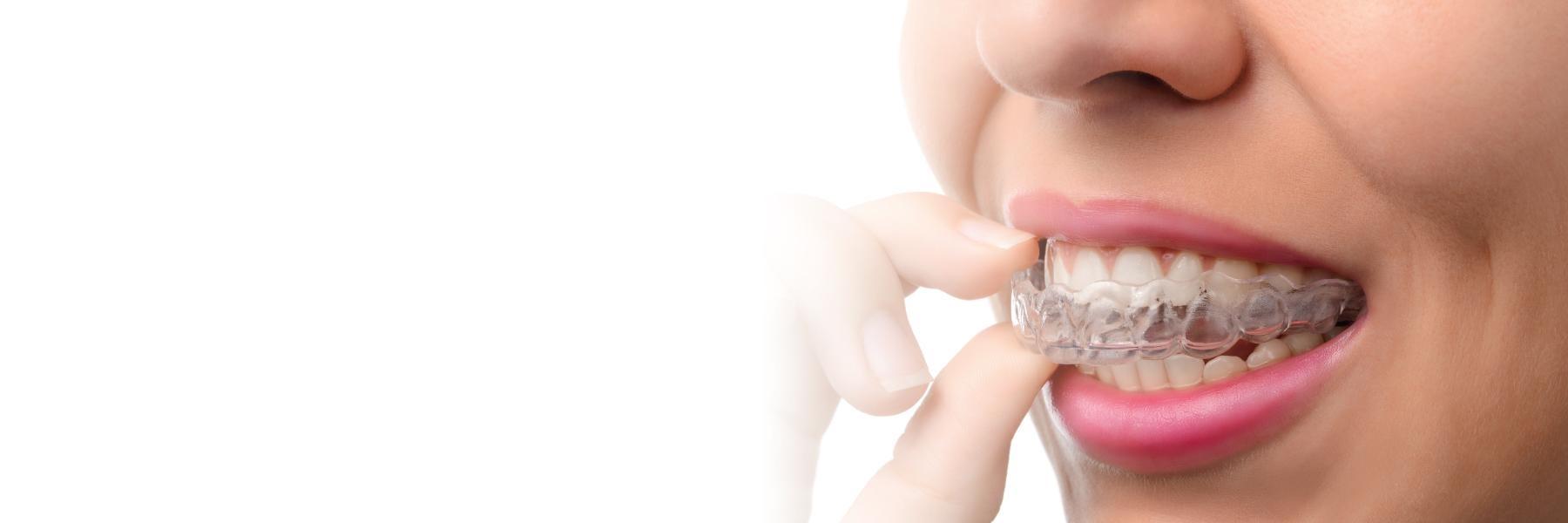 Invisalign Treatment | Dentist