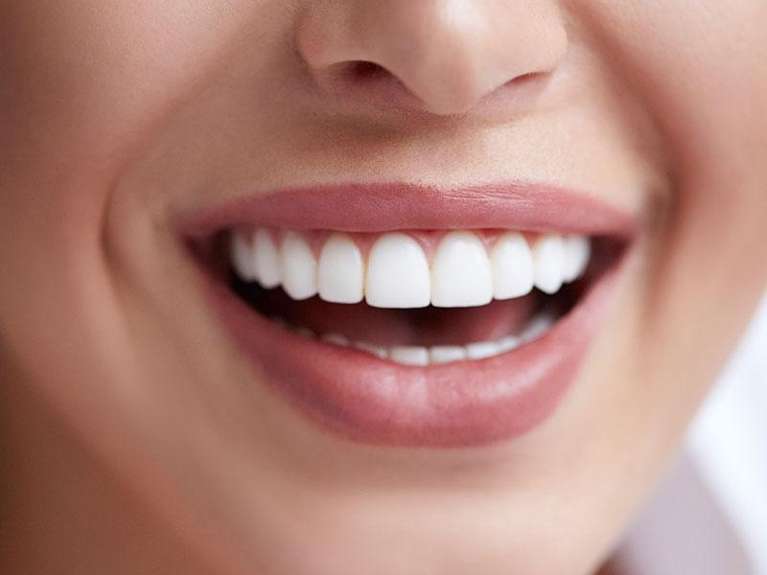 Ceramic Composite Veneers